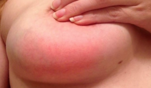 MASTITIS2