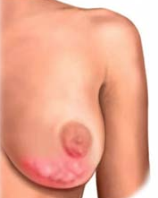 mastitis
